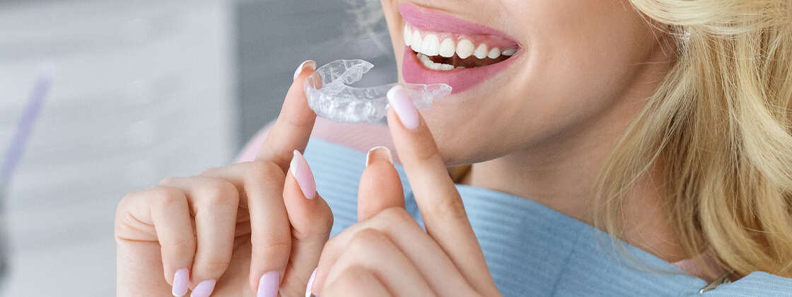 Should you buy your aligners from an online service?